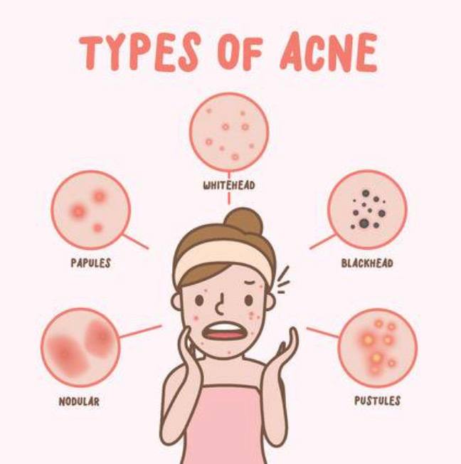 Getting to the real cause of Acne Andrea Murphy, Licensed